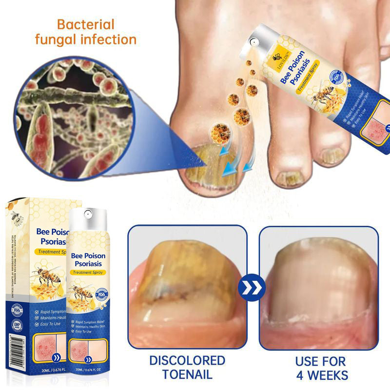 Bee Venom Psoriasis Spray
