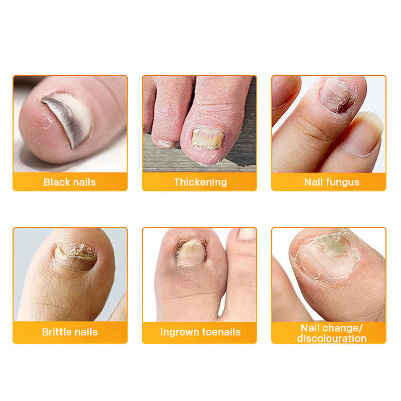 Onychomycosis stickers