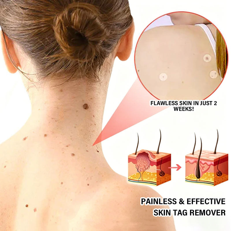 Acne and Wart Removal Microneedle Hydrocolloid Patches | - ๐Buy One Get One Free (2 Boxes)๐