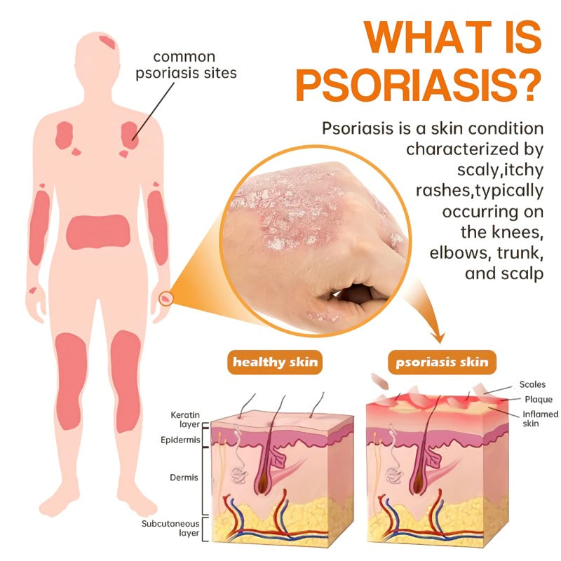 Bee Venom Psoriasis Spray