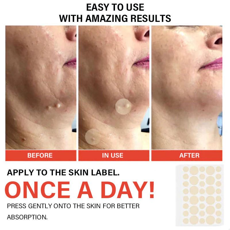 Acne and Wart Removal Microneedle Hydrocolloid Patches | - ๐Buy One Get One Free (2 Boxes)๐