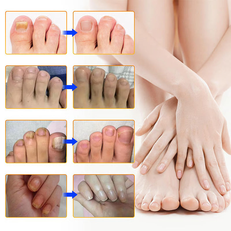 Onychomycosis stickers