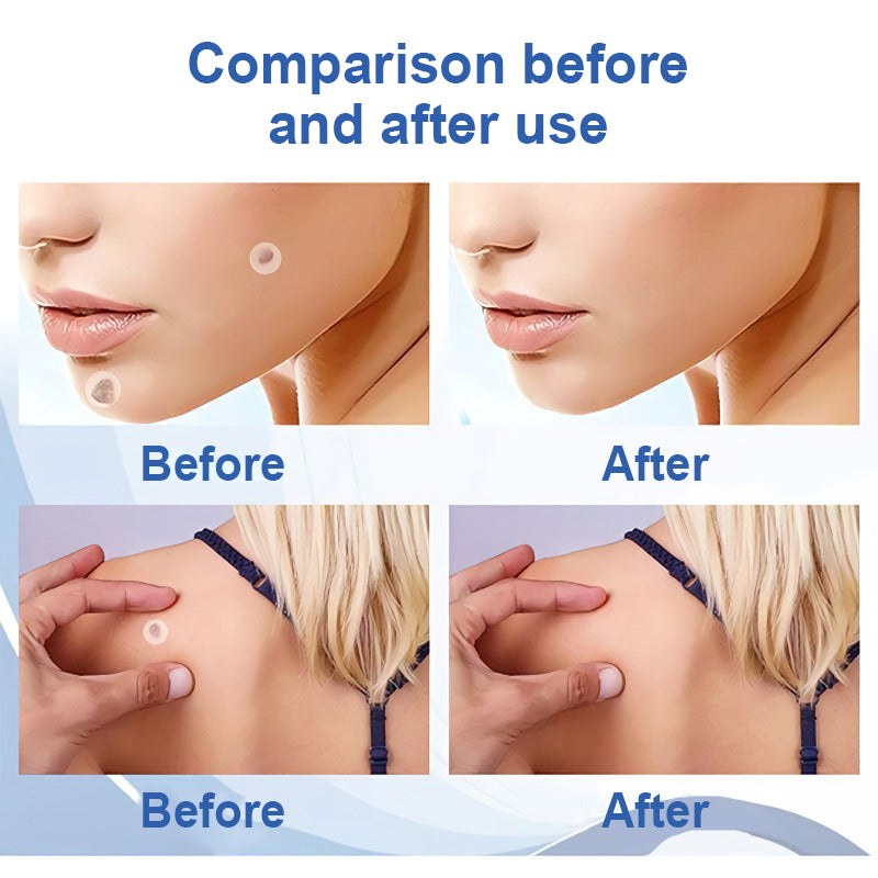 Wart and Mole Removal Patches (Buy 1 Get 1 Free)