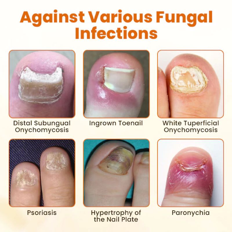 Bee Venom Nail Repair Spray