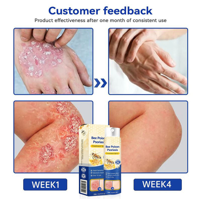 Bee Venom Psoriasis Spray