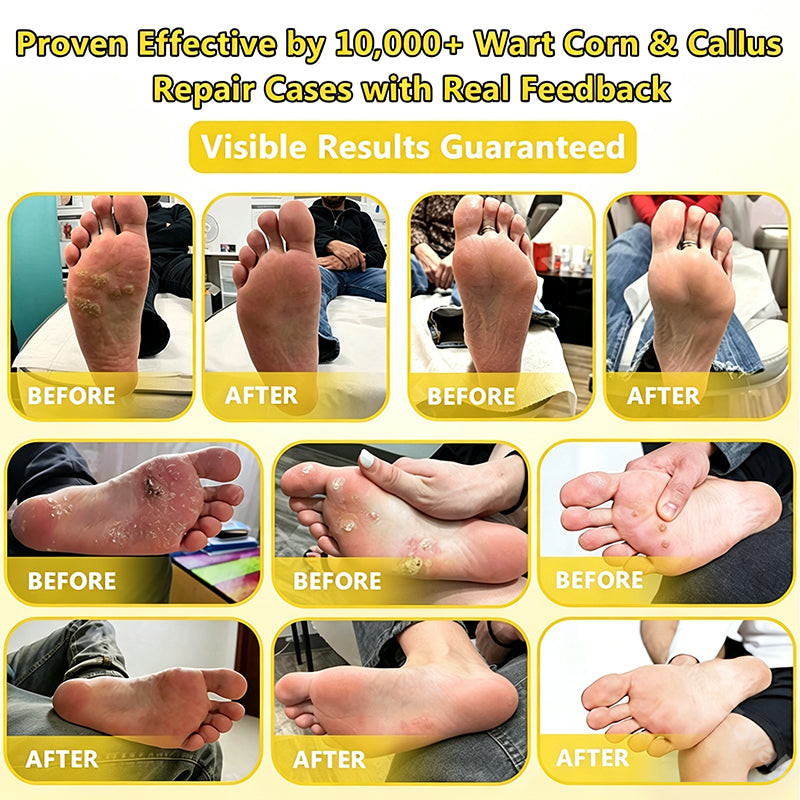 Bee Venom Corn and Callus Removal Cream
