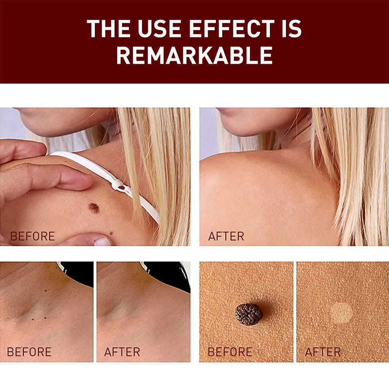 Essence for removing spots and moles