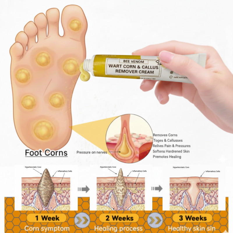 Bee Venom Corn and Callus Removal Cream