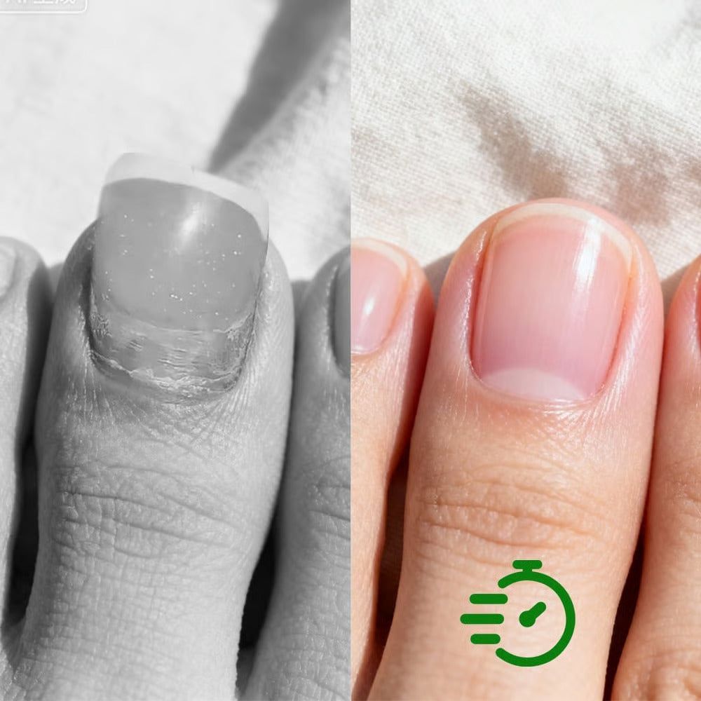 Antifungal Nail Solution
