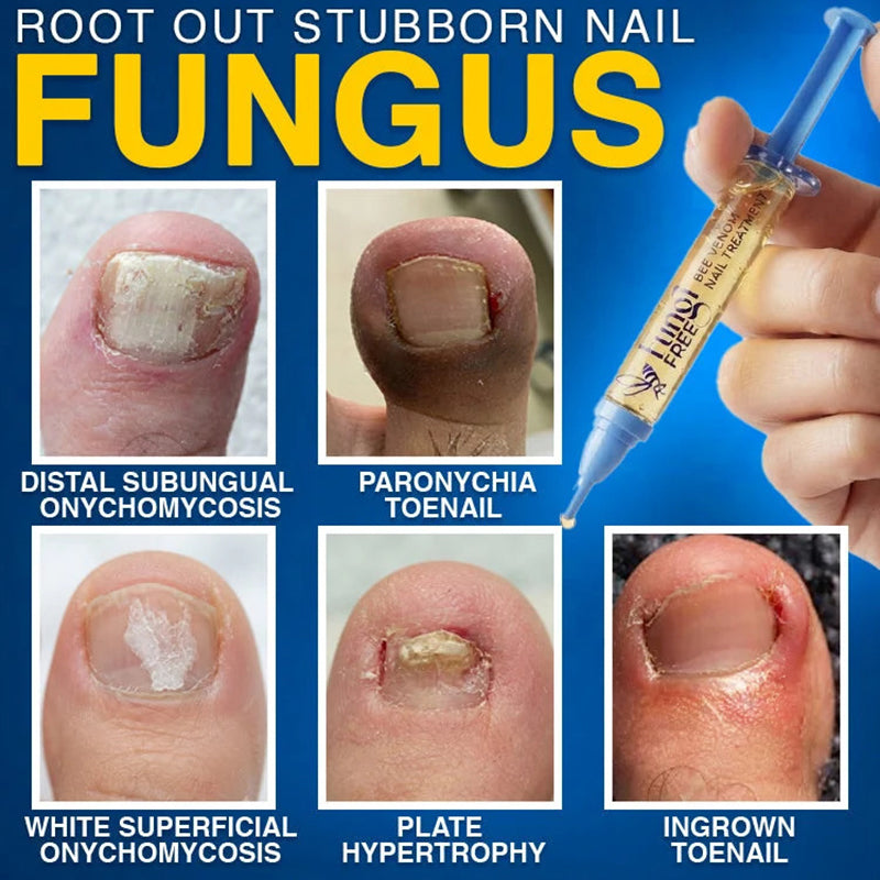 💙 Bee Venom Nail Repair Treatment Agent 🐝