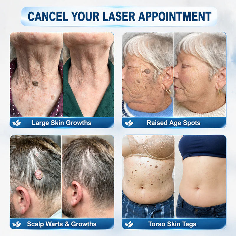 Advanced rollerball product for removing moles and warts