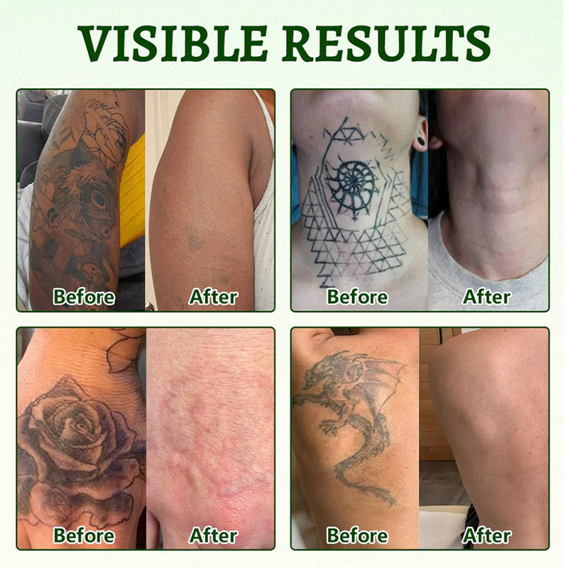 Tattoo Removal Aid Spray – Fades Stubborn Ink