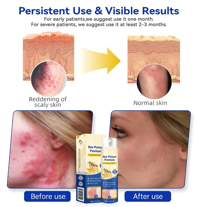 Bee Venom Psoriasis Spray