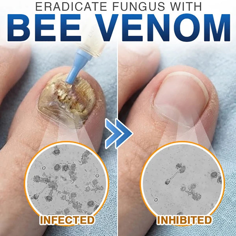 💙 Bee Venom Nail Repair Treatment Agent 🐝