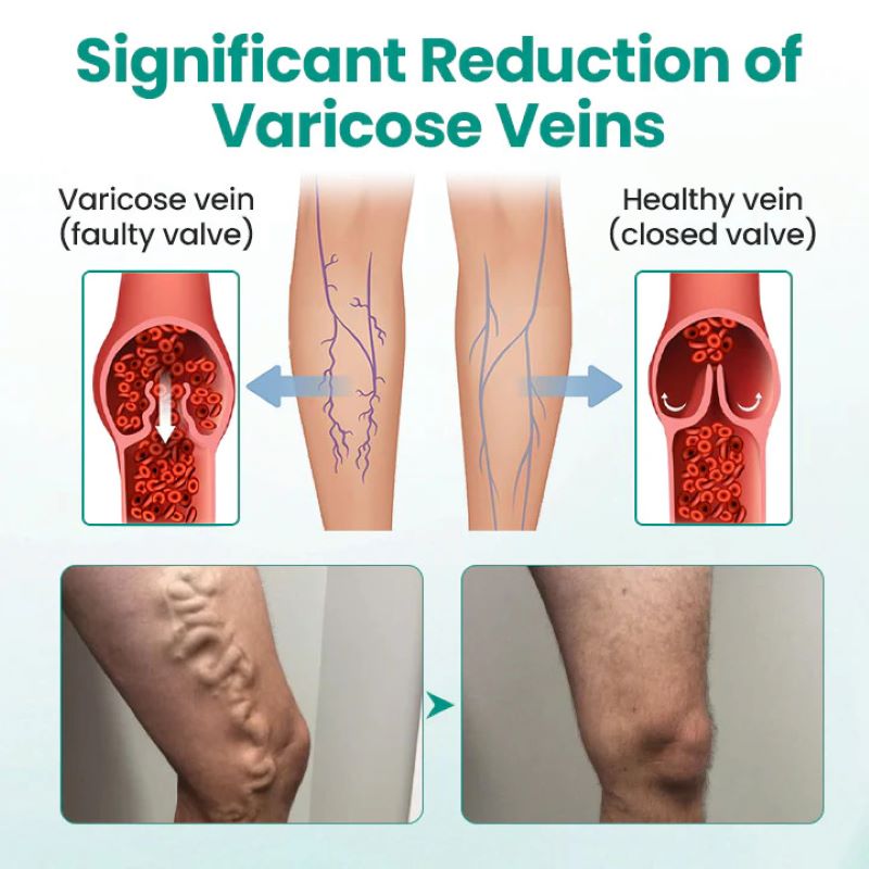 Vein Raised Topical Patch
