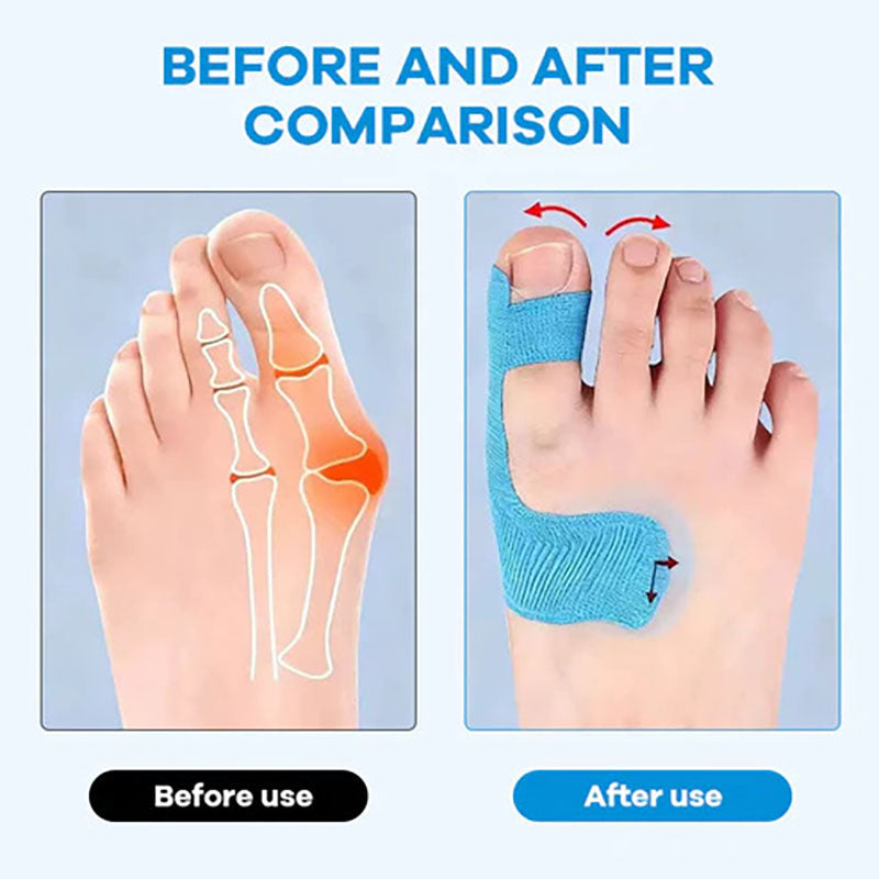 Bunion Correction Muscle Tape