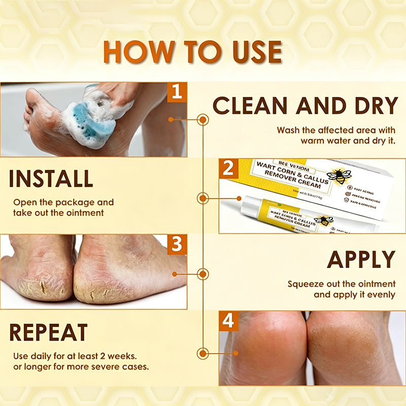 Bee Venom Corn and Callus Removal Cream