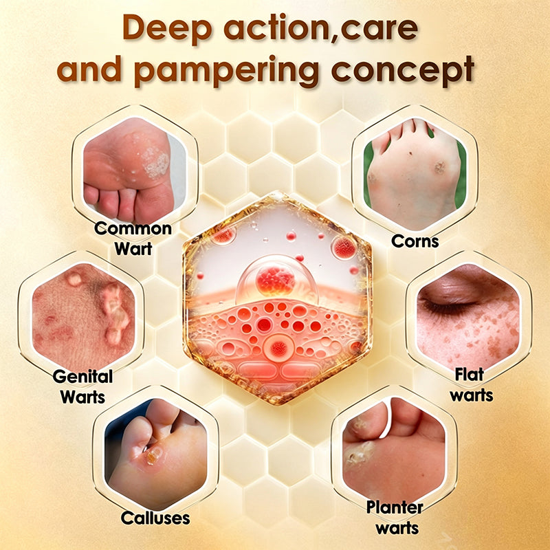Bee Venom Corn and Callus Removal Cream