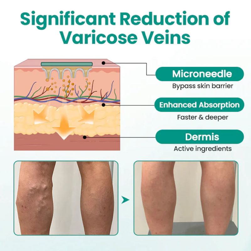 Vein Raised Topical Patch