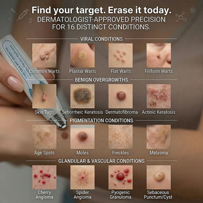 Advanced rollerball product for removing moles and warts