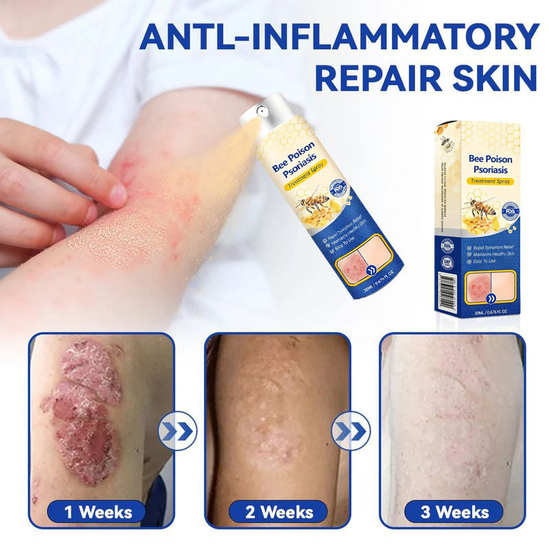 Bee Venom Psoriasis Spray