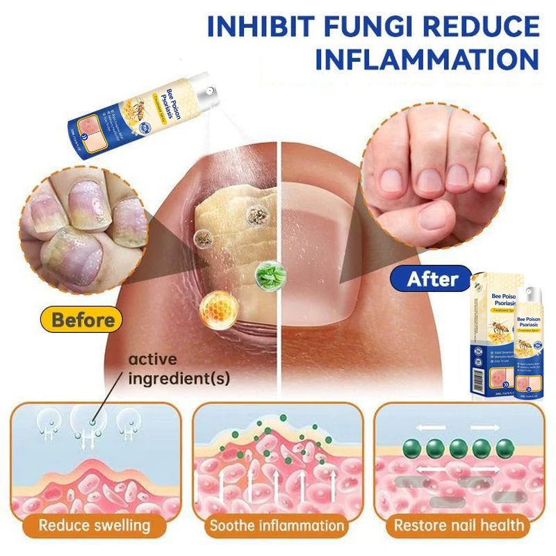 Bee Venom Psoriasis Spray