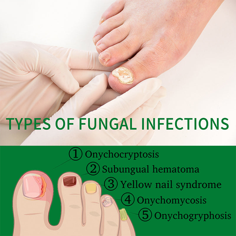 Ginger Nail Care Solution