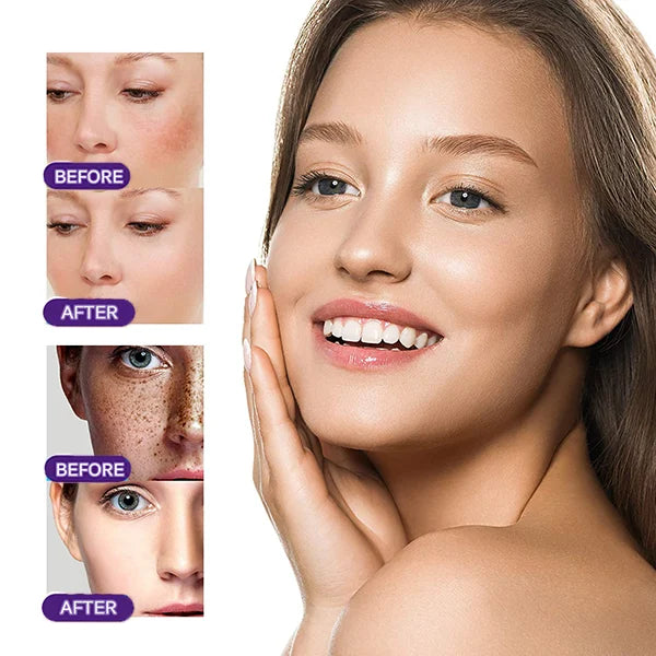 Vitamin C Freckle Dark Spot Removal Cream