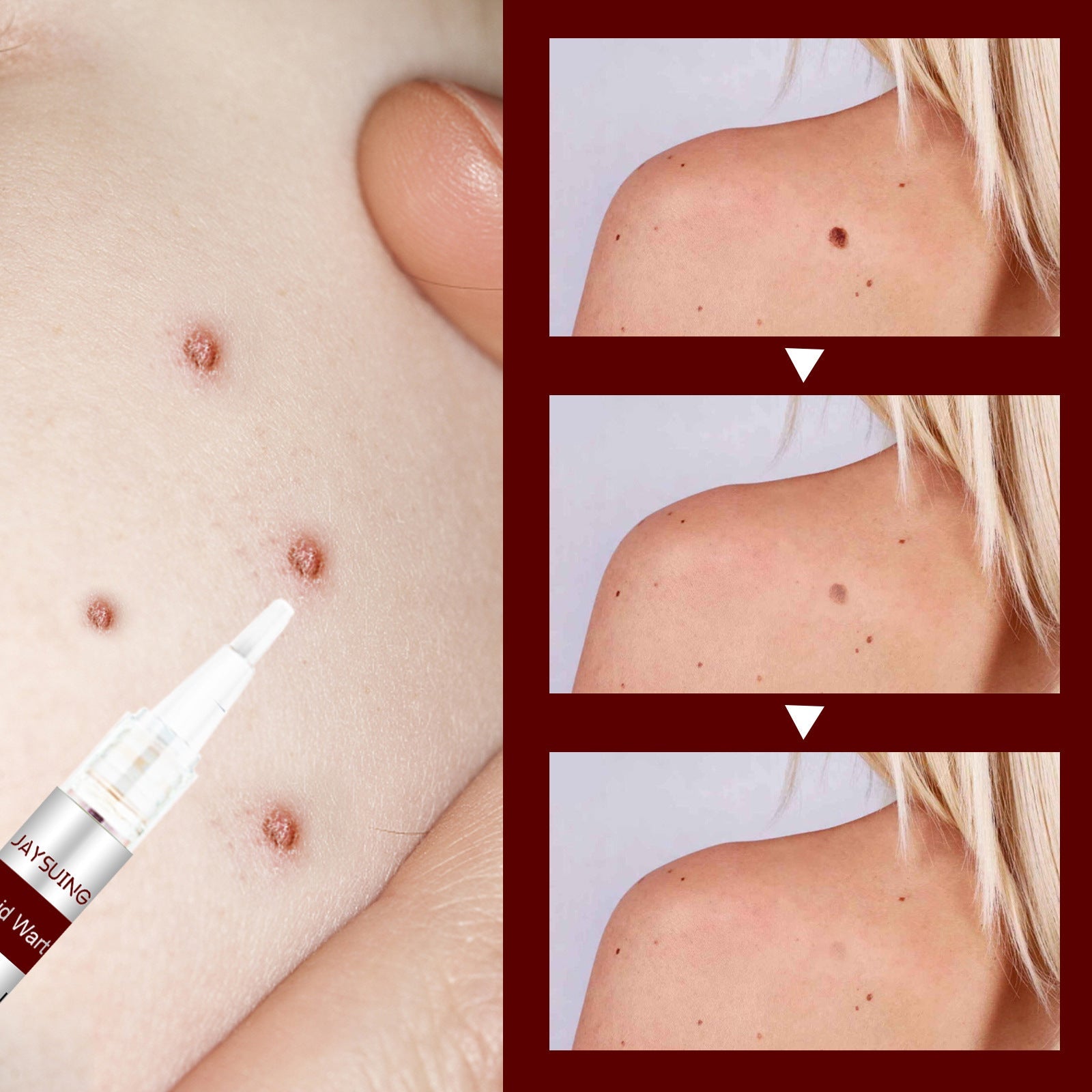 Essence for removing spots and moles